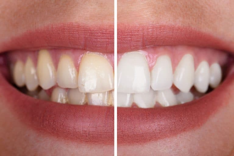 how-much-does-teeth-whitening-cost-in-fairfield-county-ct