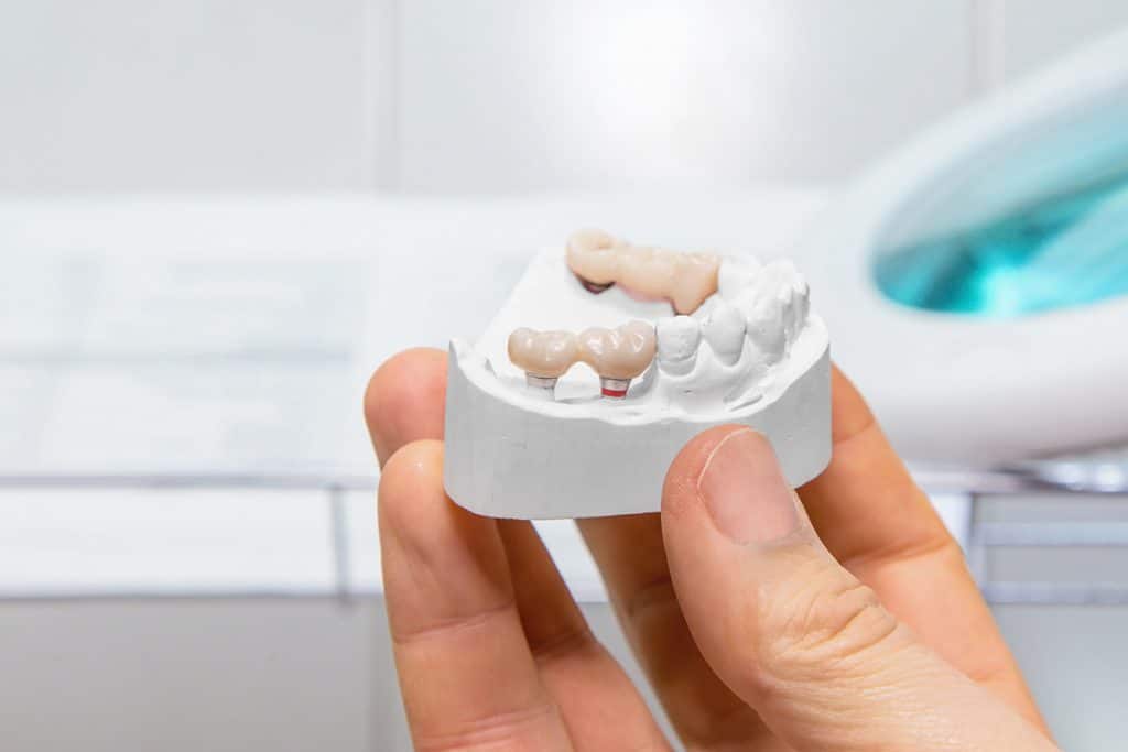 how-long-does-it-take-for-dental-bridge-to-settle